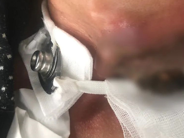 苦攻疑难肿瘤治疗，微创介入助患者重燃希望!